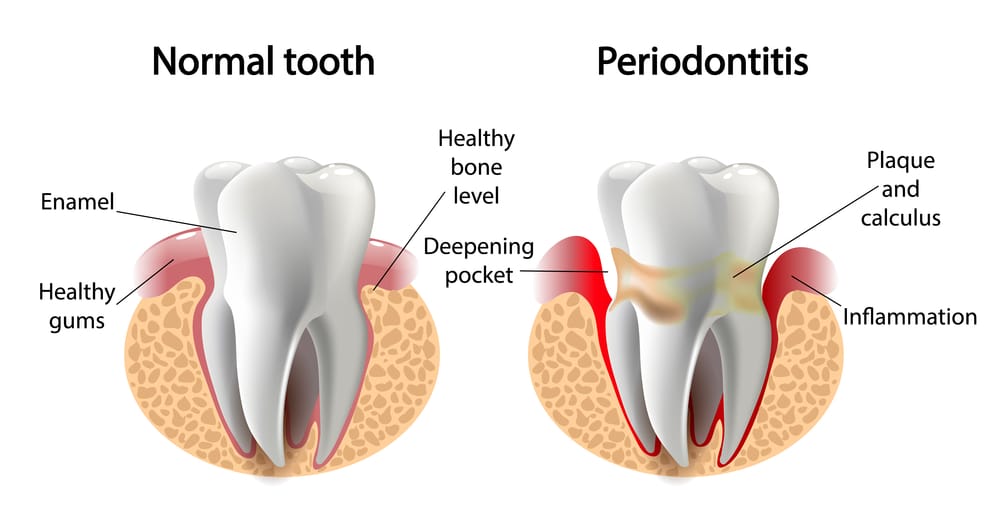 gum treatment in malviya nagar, jaipur