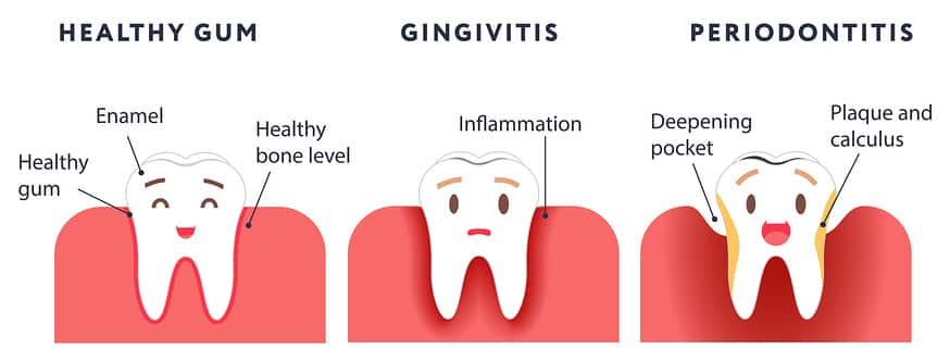 gum treatment